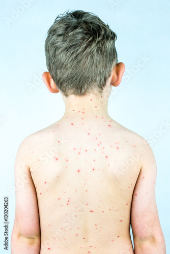 Sixth disease in adults symptoms