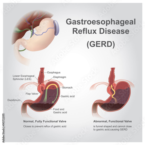 reflux gastro-esofagian ciroza hepatică