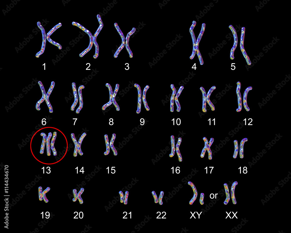 Patau Syndrome Karyotype Labeled Trisomy 13 3D Illustration Stock