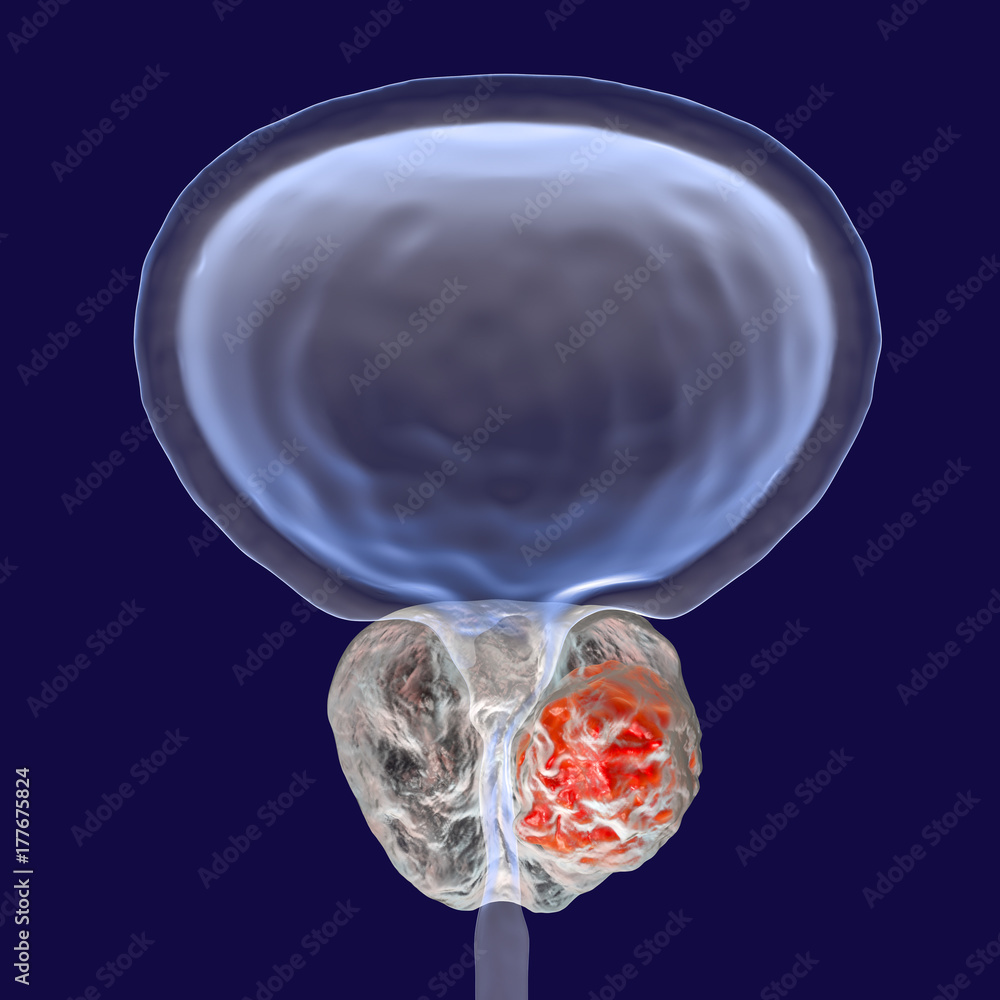 Prostate Cancer D Illustration Showing Presence Of Tumor Inside Prostate Gland Which