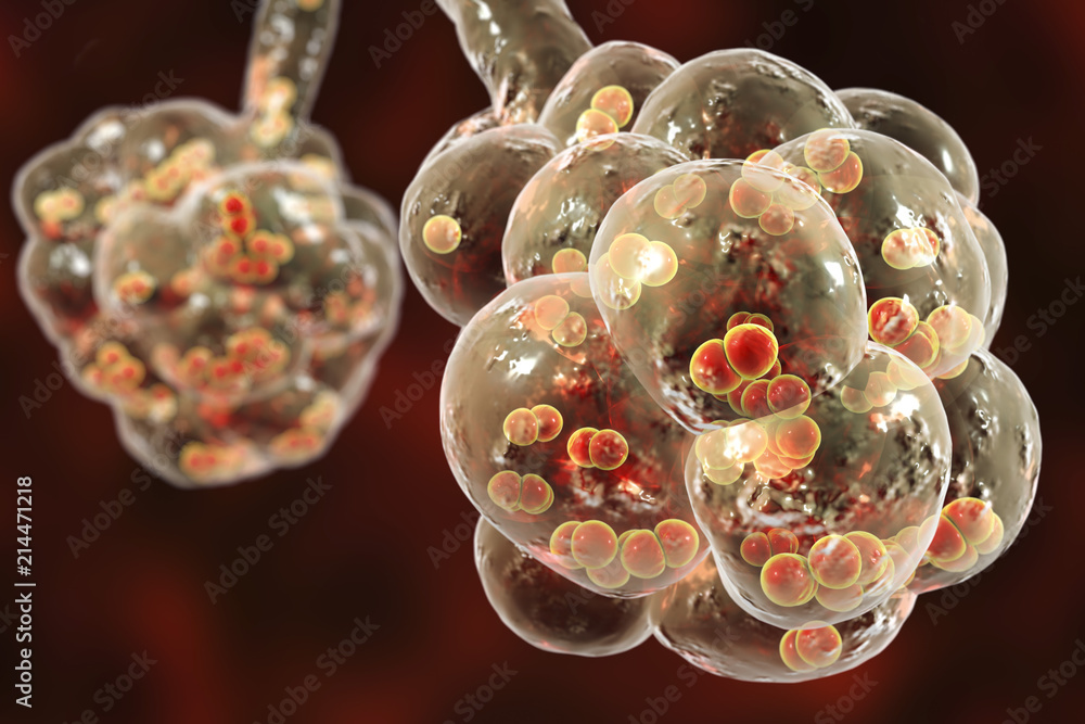 Pneumococcal Pneumonia Medical Concept 3D Illustration Showing