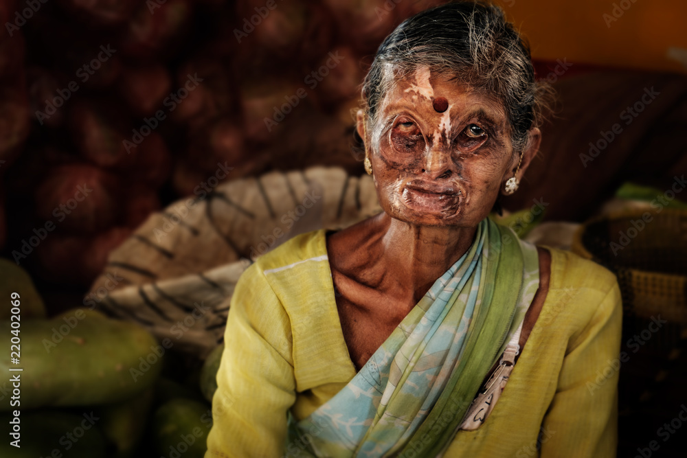 Portrait Of Elderly Indian Woman With Her Face Deformed And Scared