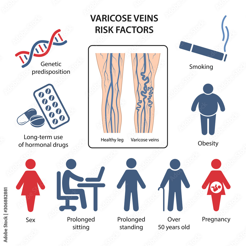 Varicose Veins Risk Factors In The Form Of Icons With Corresponding