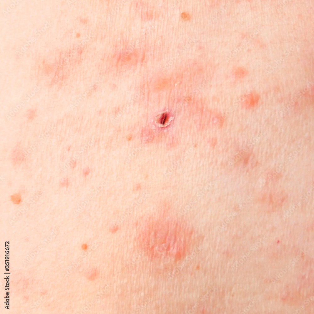 Skin Rash Treatment On Woman Body Shingles Disease Herpes Zoster