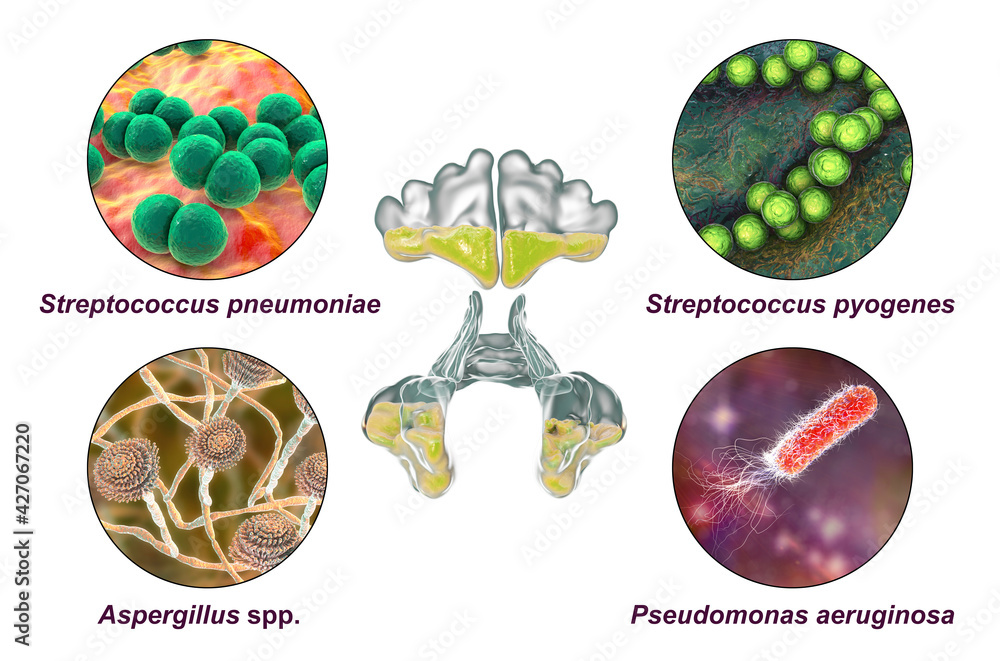 Anatomy Of Rhinosinusitis And Microorganisms That Cause Sinusitis D