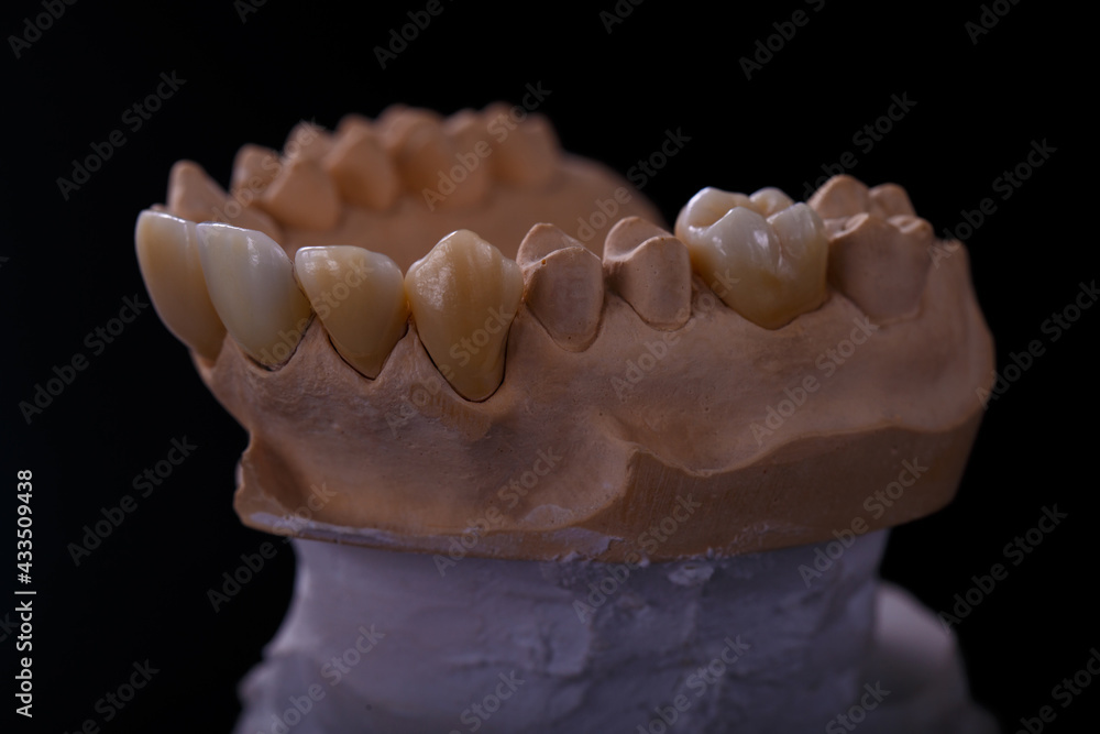 Mold Of Teeth Gypsum Model Plaster Of Teeth Stomatologic Plaster Cast