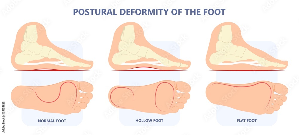 Vetor De Plantar Fasciitis Heel Pain Run Foot Bone Toes Tear Strain