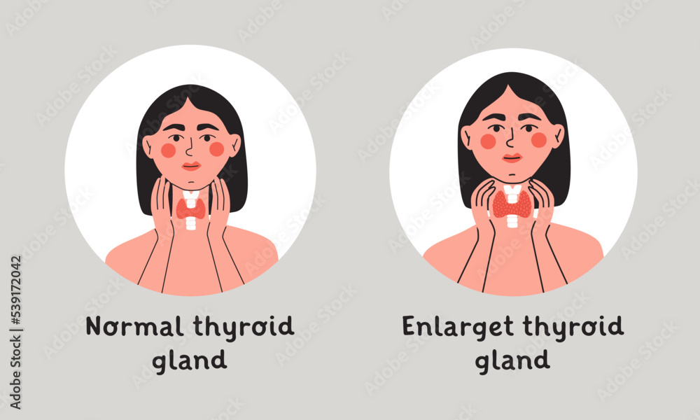 Normal And Enlarget Thyroid Gland Woman Showing Thyroid Gland On Her