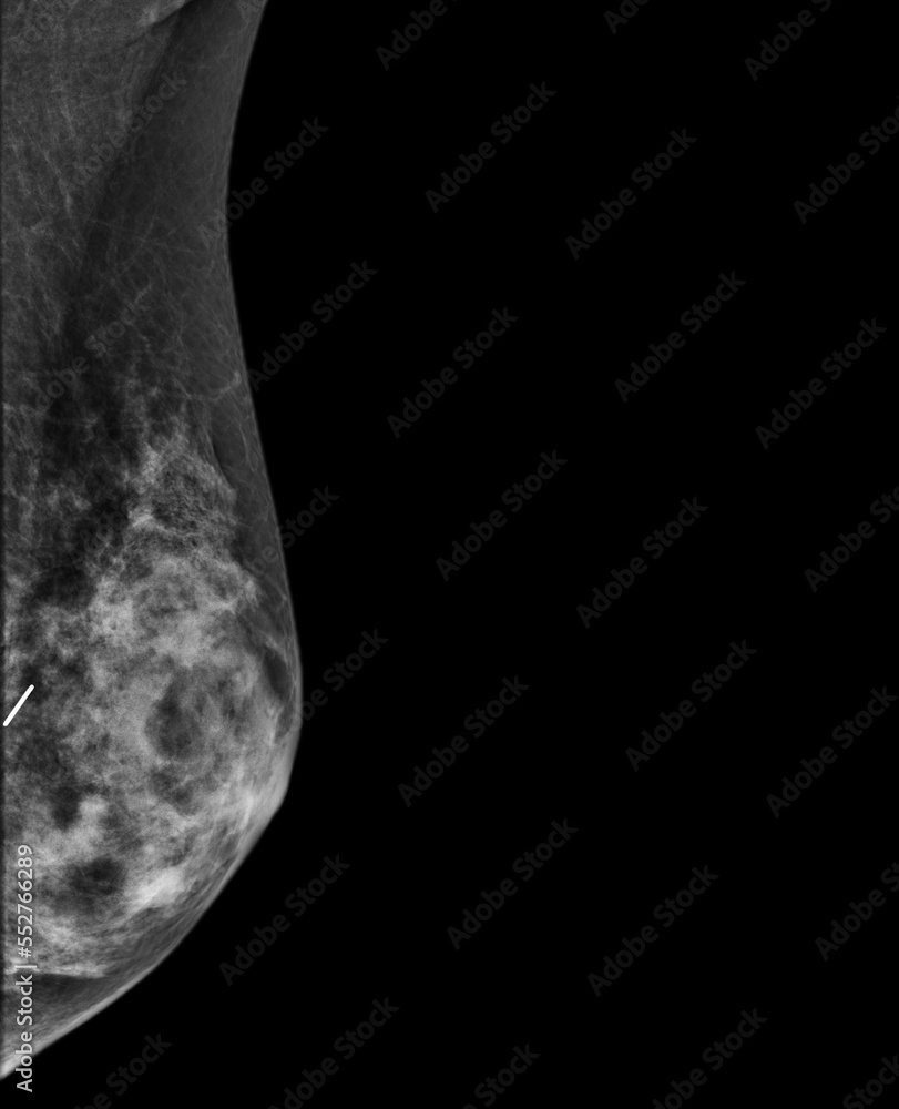 X Ray Digital Mammogram Or Mammography Of Both Side Breast Showing