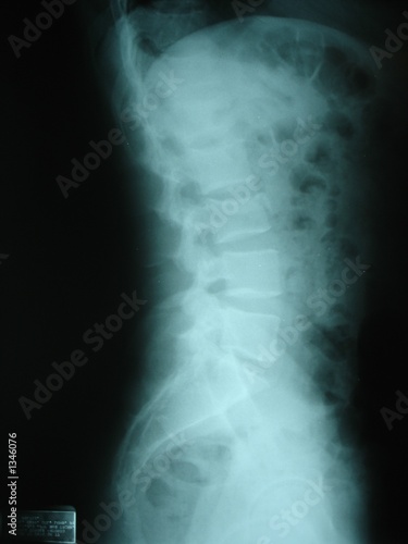 3rd lumbar vertebrae fracture Stock Photo | Adobe Stock