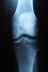 x ray photo of human knee