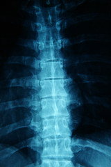x-ray of a human spine
