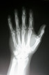 © Allen Penton - X-Ray of hand