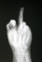 X-ray Of Hand With The Finger 