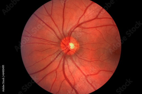 Cuadros en Lienzo Retina - Optic Nerve - Human Eye