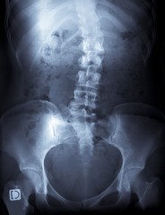 Naklejka na meble x-ray of a young female spine