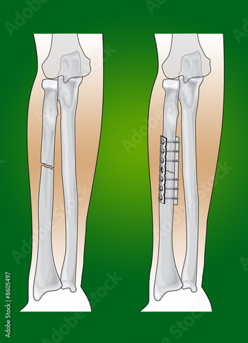 frattura radio e ulna - Acquista questa illustrazione ...