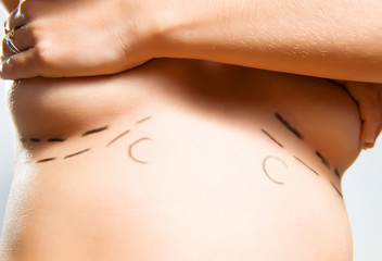 Wall Mural - Marks under breasts for cosmetic surgery