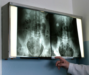 kidneys x-ray 1