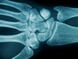 Hand wrist x-ray