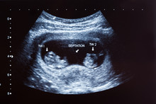 Ultrasound Scan Of 10 Months Old Twins