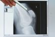 Röntgenbild eines Kniegelenkes