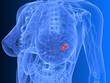 weibliche Brust mit Tumor