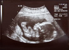Ultrasound During Second Trimester