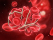 Blutgerinnsel - Thrombose
