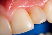 Dental Cavity - Series