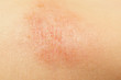 eczema on child skin