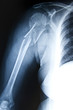 © Tim Glass - Humerus Fracture - Trauma Xray