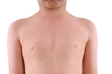 Close up image of a little boy’s body suffering urticaria.