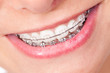 Mund mit Zahnspange und schönen Zähnen