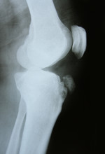 X-ray Image Of The Bones Of Leg