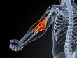3d rendered medical illustration of an elbow bursitis