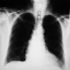 radiograph of human chest