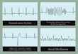 Examples of normal and abnormal ECG. Vector.