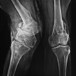 radiografia di ginocchia patologiche