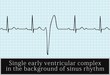 single ventricular beat. vector. Information for Professionals