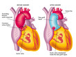 aneurisma aortico toracico