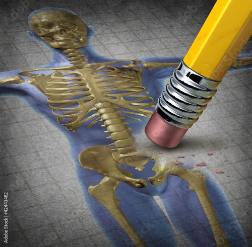 Obraz w ramie Human Osteoporosis