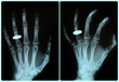 röntgenbild hand