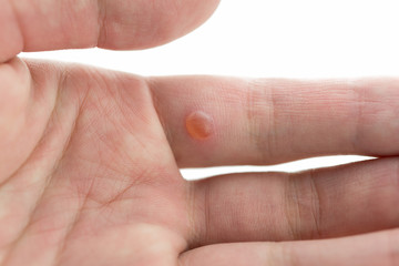 hand with wart isolated on white background