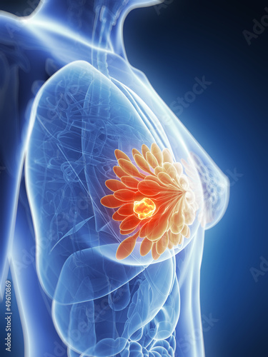 Plakat na zamówienie 3d rendered illustration - breast cancer