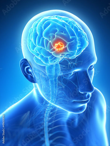 Naklejka - mata magnetyczna na lodówkę 3d rendered illustration - brain tumor