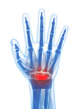 3d Rendered Illustration Of The Carpal Tunnel Syndrome