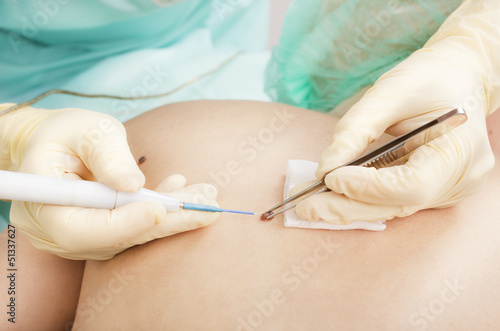 Fotografie, Obraz Dermatologist removes mole electrocoagulation method.