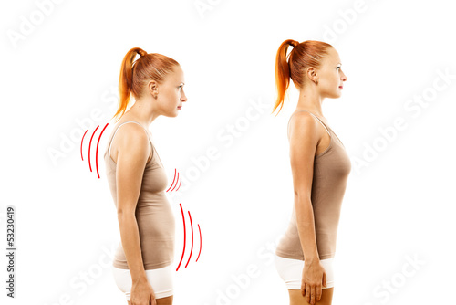 Cuadros en Lienzo Young woman with position defect and ideal bearing