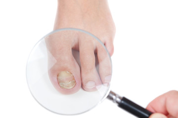 Doctor dermatologist examines the nail on the presence of the fu